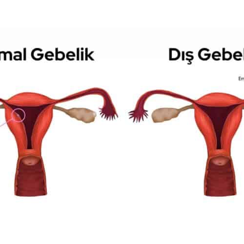 Dış Gebelik Nedir?