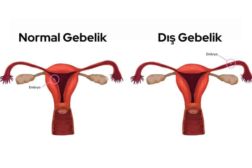 Dış Gebelik Nedir?