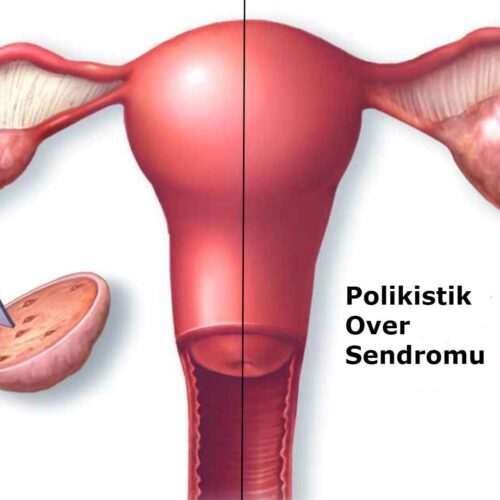 Polikistik Over Sendromu